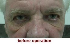 plastic-surgery-blepharoplasty